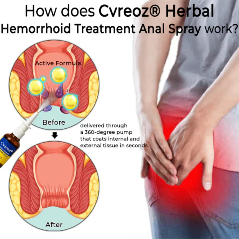 Cvreoz® Herbal Hemorrhoid Treatment Anal Spray (Buy 1 Get 1 Free) Secondary image